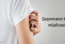 Qaşınmanın təbii yolla mualicəsi üsulları