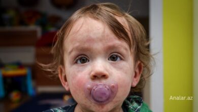 Usaqlarda allergiya sepkileri 